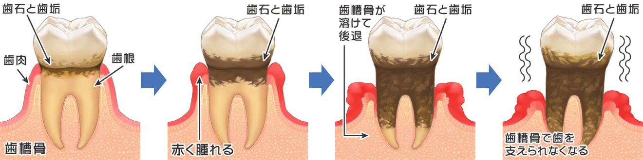 歯周病の進行