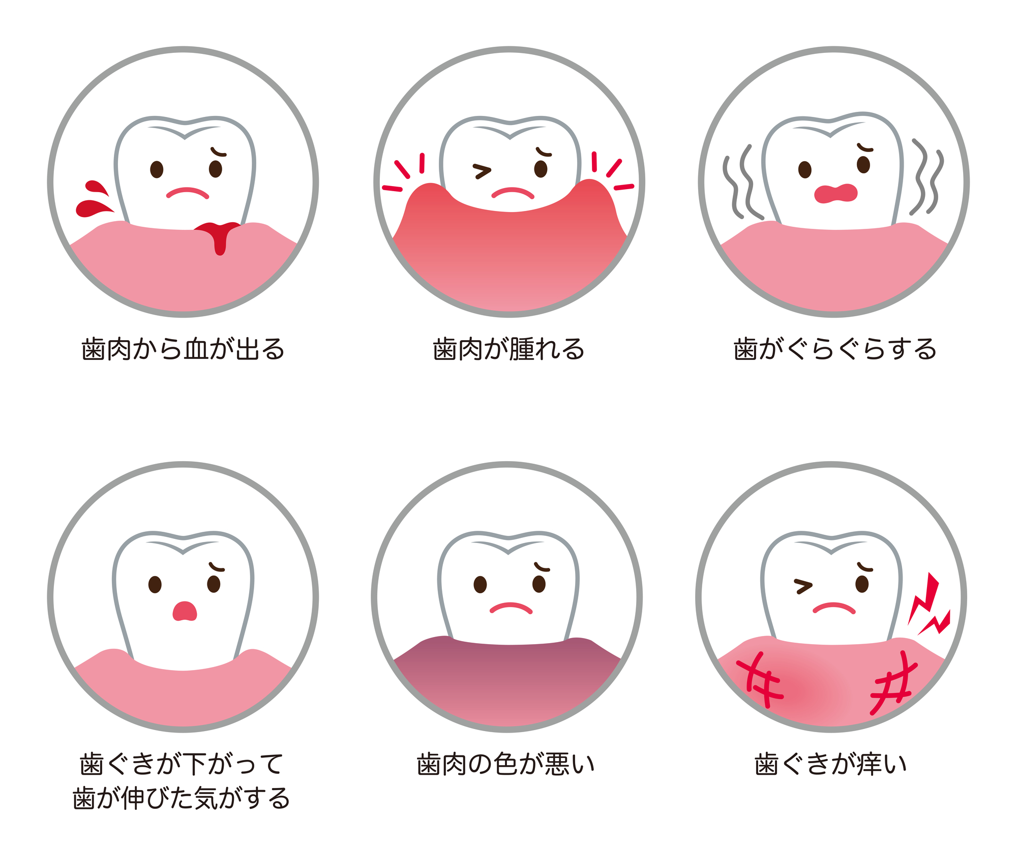 歯周病の種類