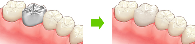 セラミック治療とは