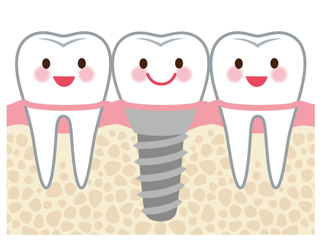 インプラント治療とは