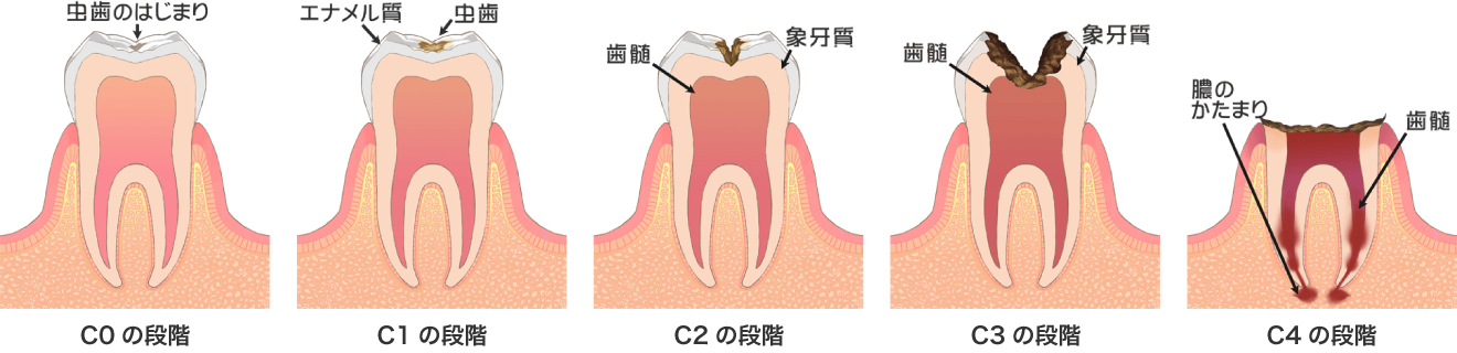 虫歯の進行