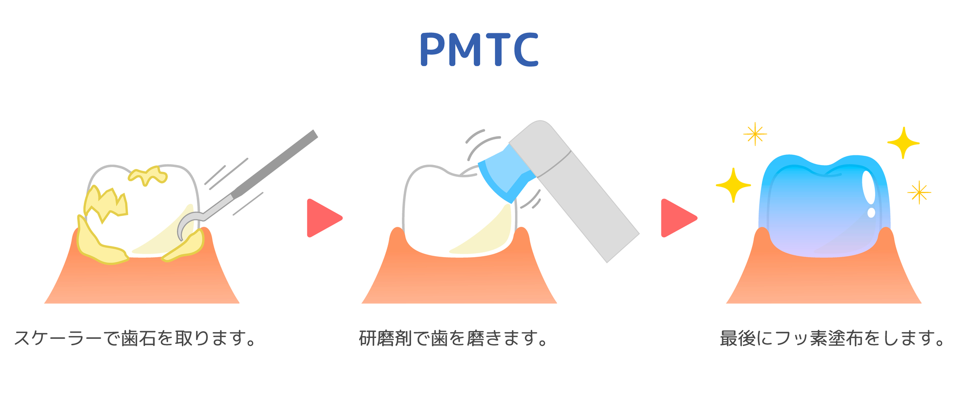 歯のクリーニング・PMTC